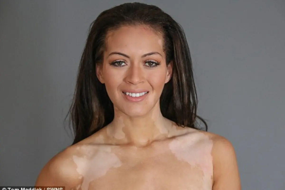 Dengan Vitiligo, Laura Sukses Jadi Model Internasional
