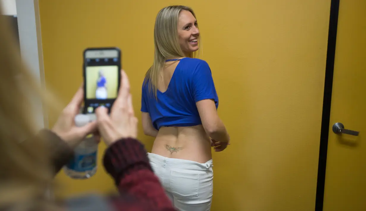 Janica Polmanteer menunjukkan tato usai dihapus dengan metode laser di klinik Dr. Tatoff, California, Rabu (11/5). Salah satu metode penghapusan tato paling populer adalah laser. (AFP PHOTO/DAVID McNew)