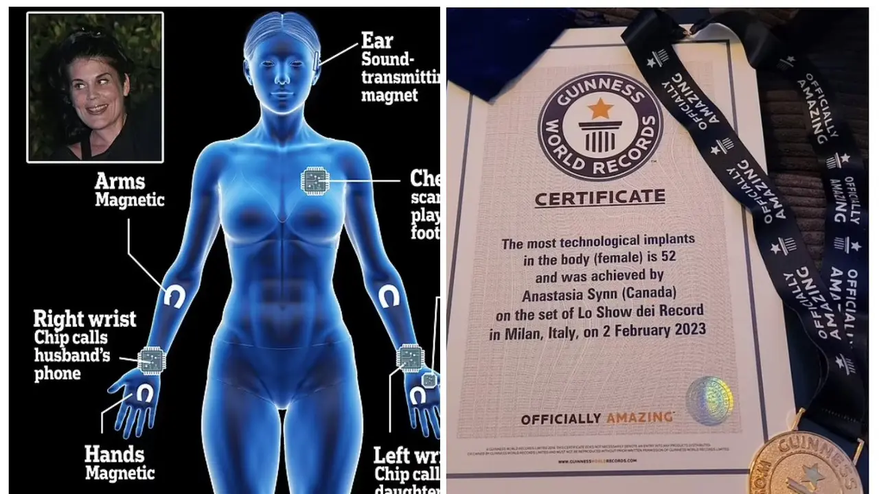 Wanita dengan 52 Implant Pecahkan Rekor Dunia