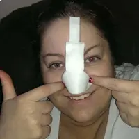 Derita penyakit kanker kulit, perempuan ini punya hidung baru yang berbulu lebat.