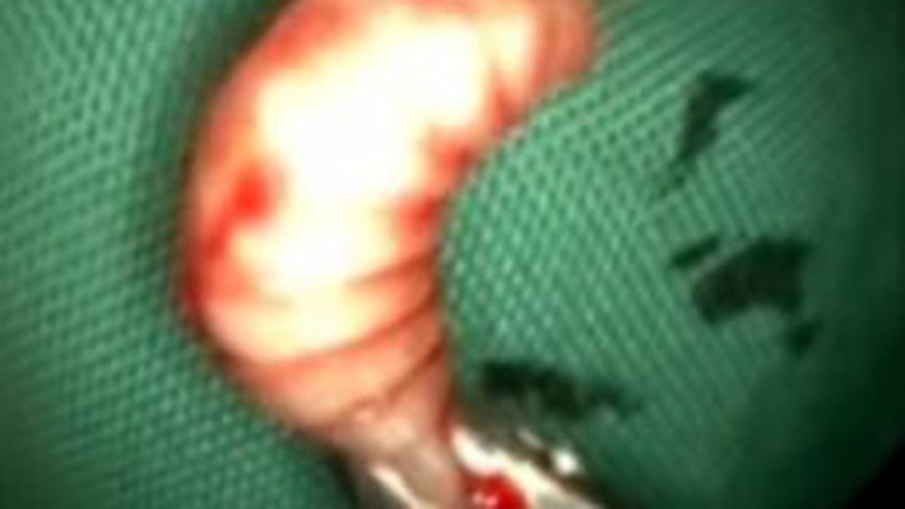 Belatung yang hidup di rongga hidung pria India. (YouTube)