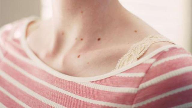 [Bintang] Studi: Tahi Lalat di Lengan Kanan Indikasikan Kanker Kulit