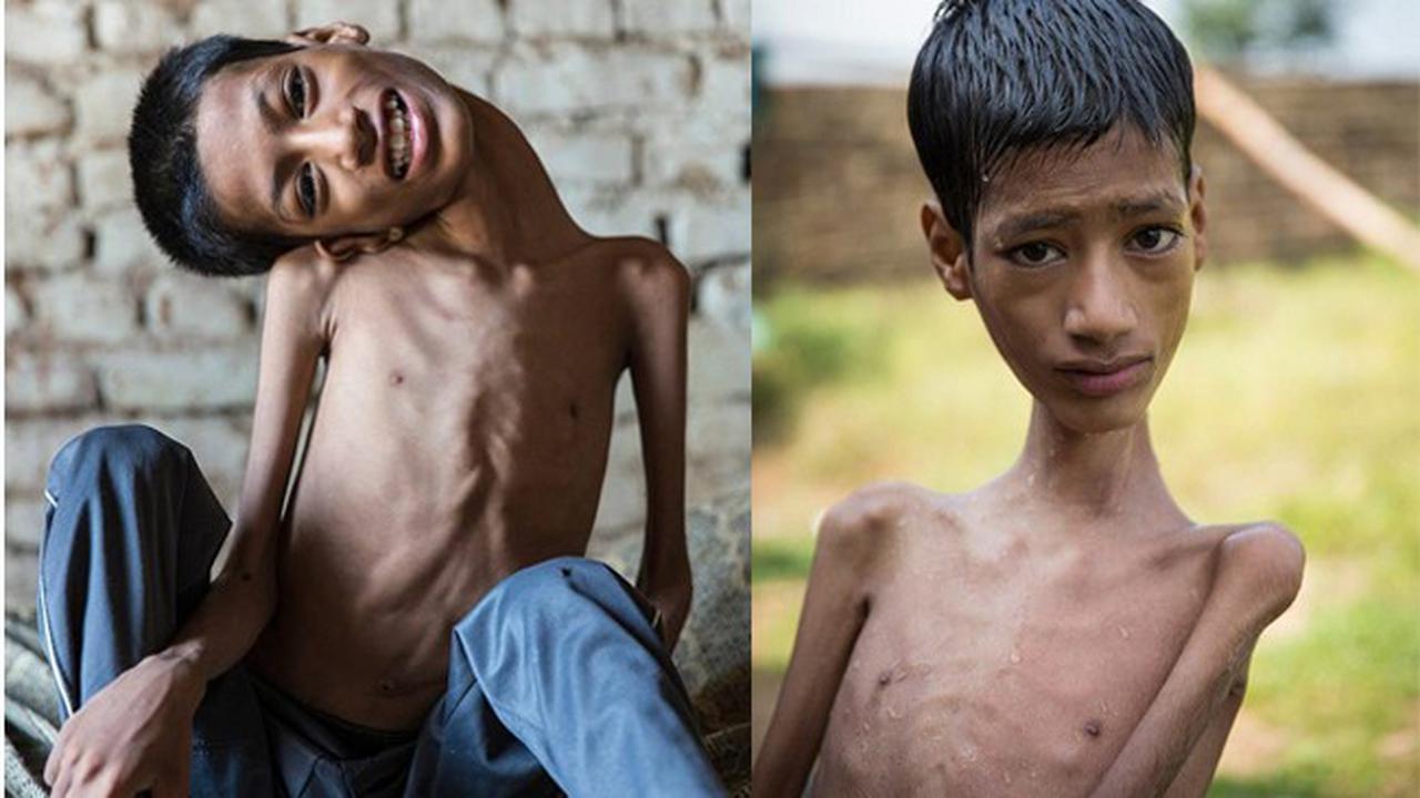 12 Tahun Lihat Dunia Secara Terbalik, Hidup Mahendra Kini...