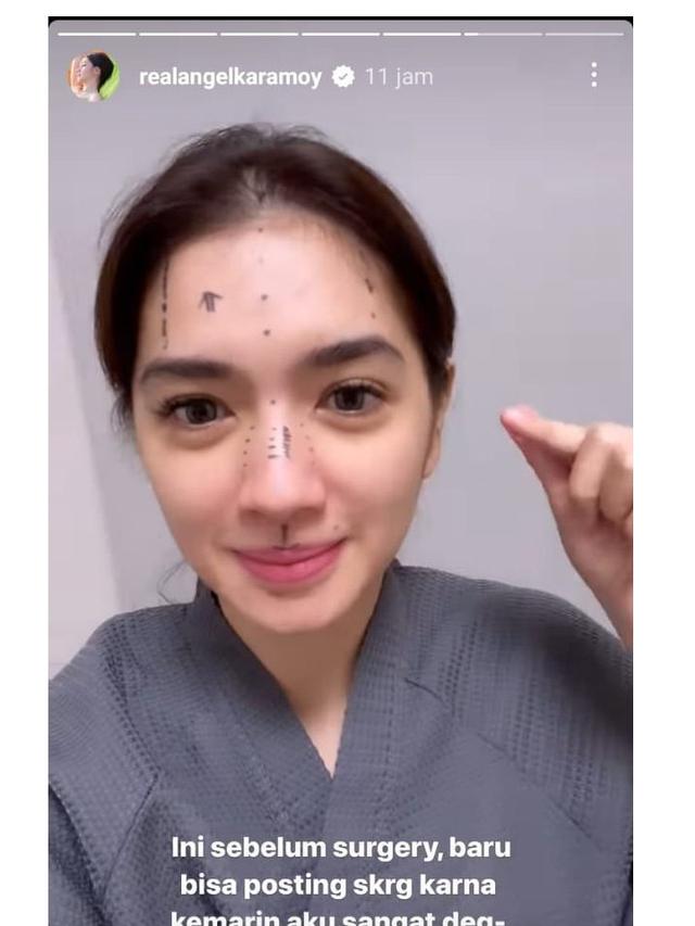 8 Potret Angel Karamoy Jalani Operasi Plastik di Korea Selatan, Curi Perhatian