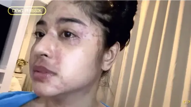7 Potret Dewi Perssik saat Alami Gejala Corona Covid-19, Penuh Ruam Merah