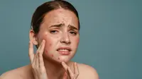 Cegah Jerawat Pecah Berbekas, Yuk Lakukan Rutinitas Perawatan yang Tepat!