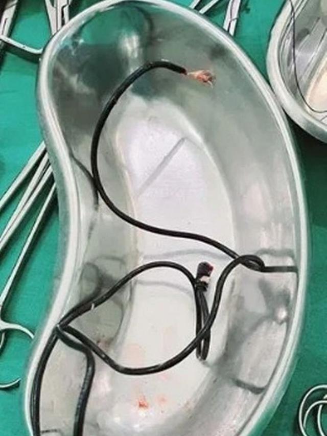 Kabel 60 Cm Ditemukan dalam Kandung Kemih Pria Ini, Buat Kepuasan Seksual?
