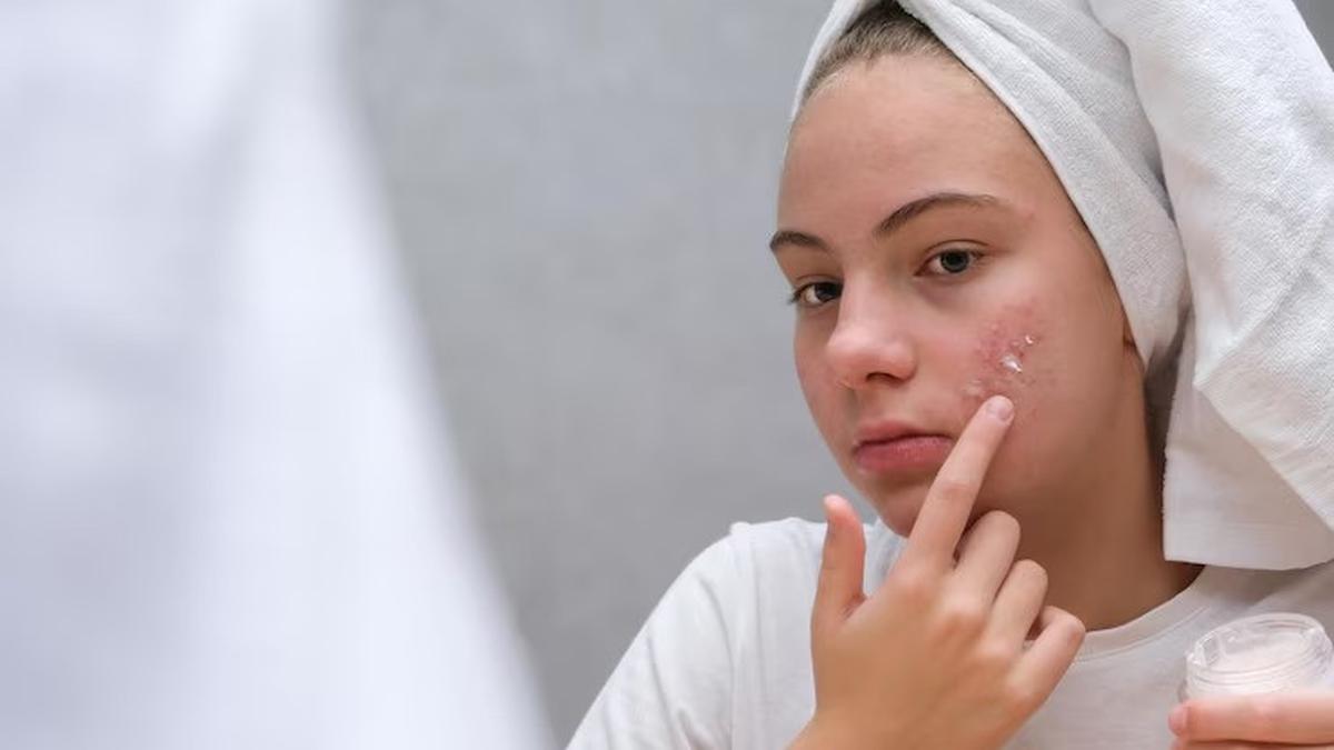 Wanita Ini Dilarikan ke IGD Usai Pecahkan Jerawat di Titik Terlarang pada Wajah