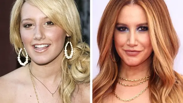 artis sebelum vs setelah operasi plastik