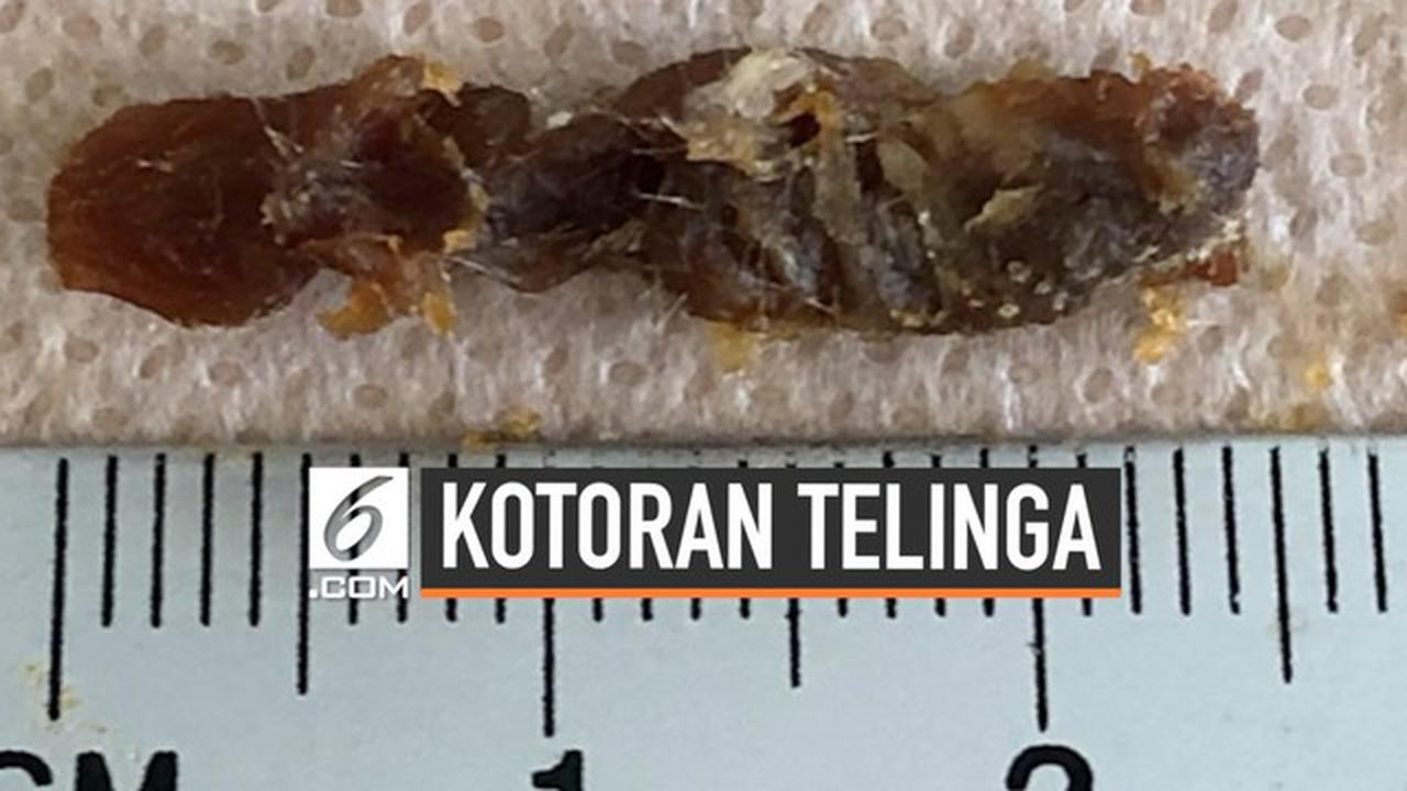 VIDEO: Kotoran Telinga Terpanjang di Dunia Berhasil Dikeluarkan