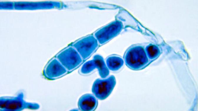 Mengenal Ringworm si Jamur Kulit - Health Liputan6.com