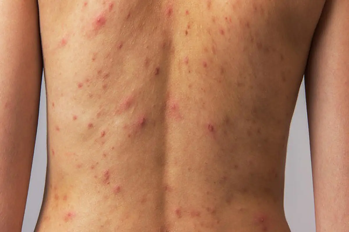 Jerawat di punggung. (Foto: Men's Health)