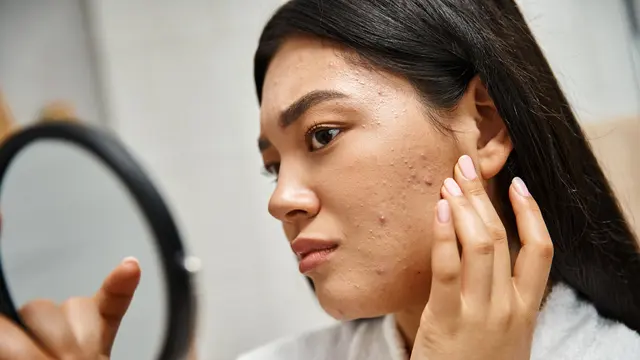 Treatment di Klinik Kecantikan Seperti Apa Sih yang Bisa Singkirkan Bekas Jerawat? Ini Jawabannya!