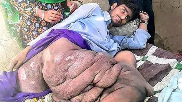 Miliki Tumor 20 Kg di Kaki, Remaja Harap Bantuan Pengobatan