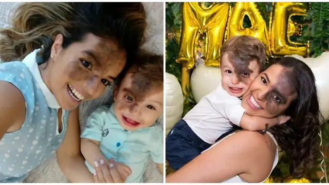 Anak Miliki Tanda Lahir Hampir di Seluruh Wajah, Perlakuan Sang Ibu Ini Bikin Terharu