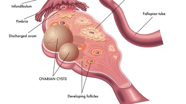 Tanda Kista Ovarium Dilihat dari Vagina
