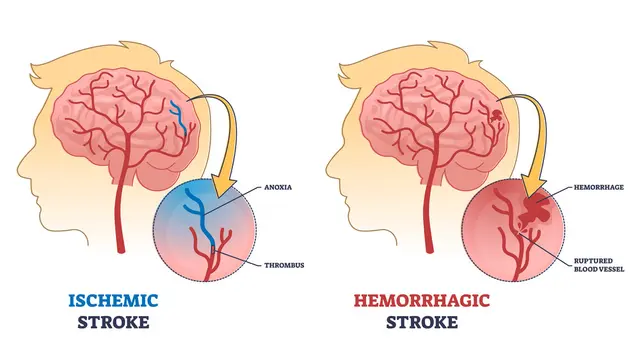 Kenali Risiko Stroke Sejak Dini, Begini Gejala dan Cara Penanganannya
