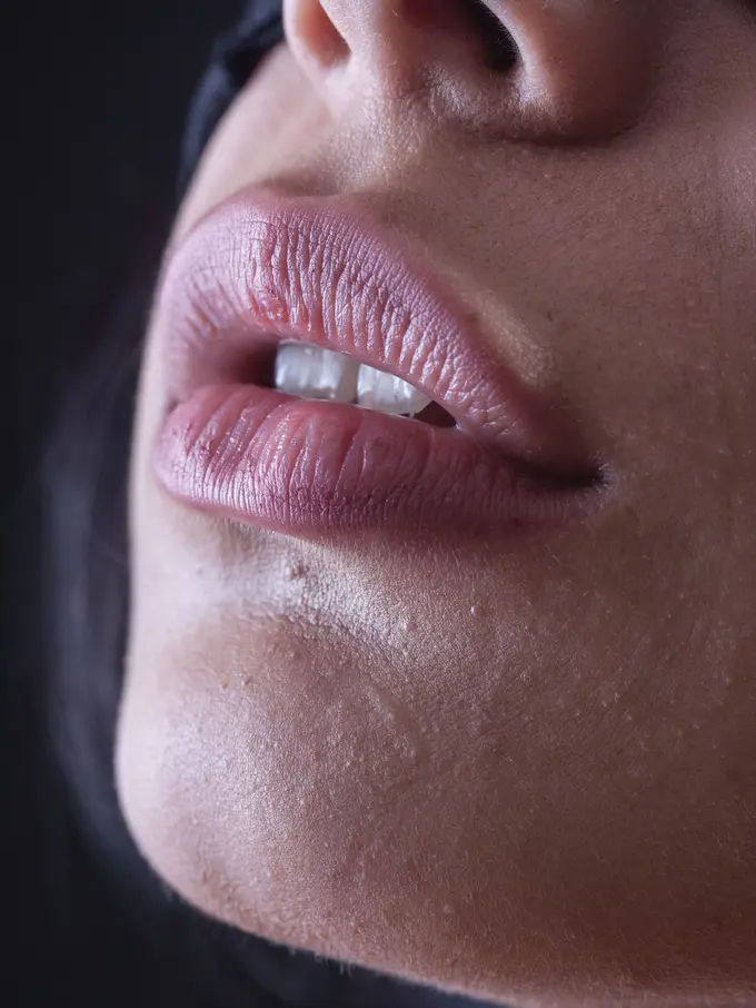 Intip cara ampuh untuk menghilangkan komedo membandel di pinggir bibir.