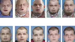 Perubahan wajah Patrick Hardison saat menjalani bedah plastik di Langone Medical Center NYU, New York, Amerika Serikat, (16/11/2015). Pria berusia 41 tahun tersebut menjalani operasi selama 95 hari. (REUTERS)