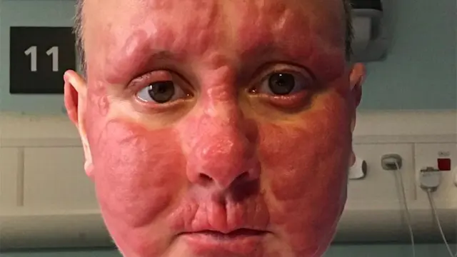 [Bintang] Terkena Kanker, Wajah Wanita Ini Tak Dikenali Lagi, tapi Ia Bersyukur karena Anak-anaknya Tidak Akan Mengingatnya