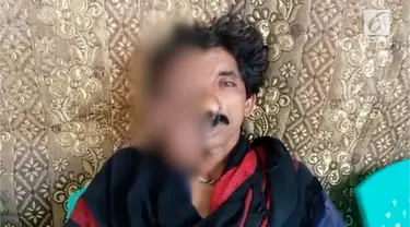 Seorang Pria asal Pakistan mengidap tumor langka di wajahnya sejak usia 2 tahun.