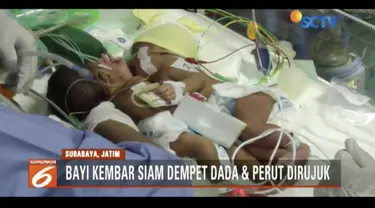 RSUD Dokter Soetomo Surbaya, kembali menangani bayi kembar siam dempet perut dan dada, setelah mendapati rujukan dari Rumah Sakit Ibu dan Anak Fatimah Lamongan.