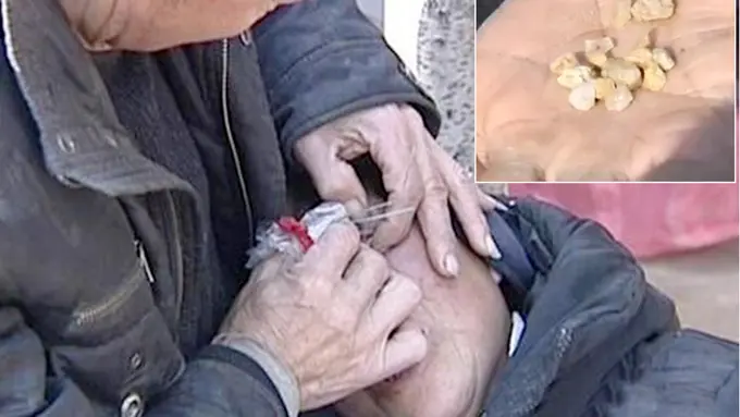 Keluarkan 'Air Mata' Batu, Perempuan Ini Cari Obat Keliling Cina