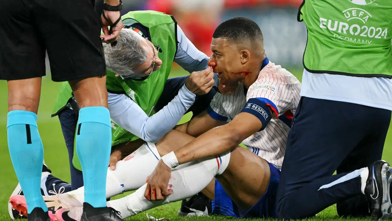 Foto: Momen Benturan Keras Kylian Mbappe dengan Pemain Austria, Berdarah-darah Hingga Tulang Hidung Patah