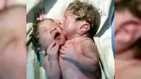 Momen Mengharukan 2 Bayi Kembar Siam Saling Cium