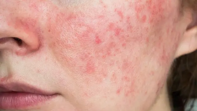 Rosacea