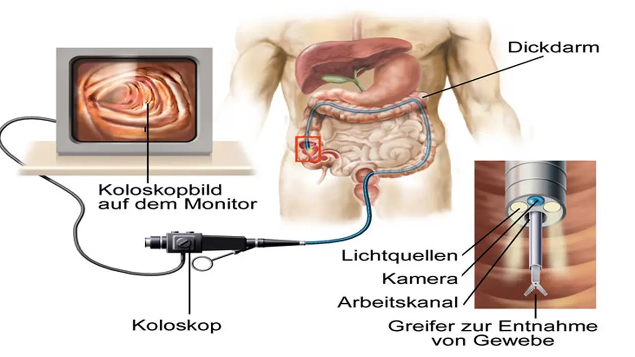 Deteksi Kanker Usus Besar
