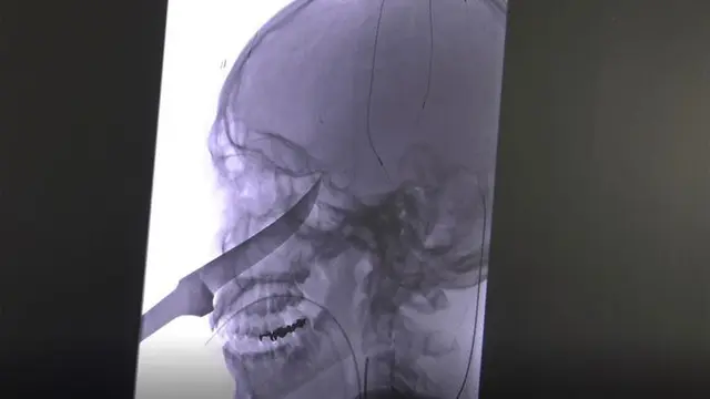 Gambar rontgen pisau yang tertancap pada wajah si anak, nyaris mencapai otaknya (University of Kansas Health)