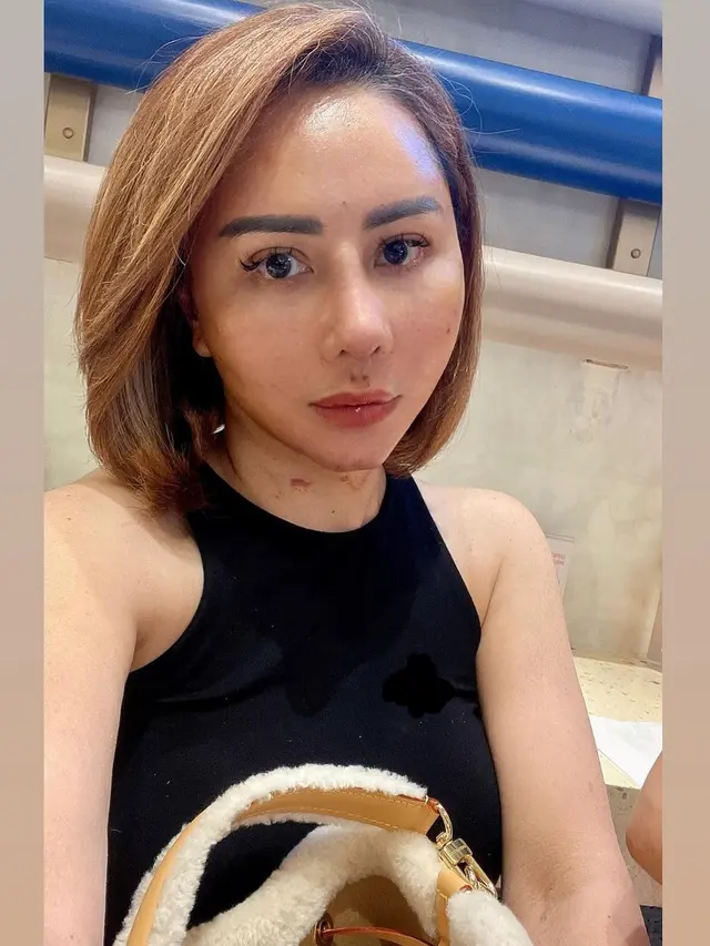 8 Potret Femmy Permatasari Pamer Wajah Usai Lakukan Operasi Plastik, Curi Perhatian