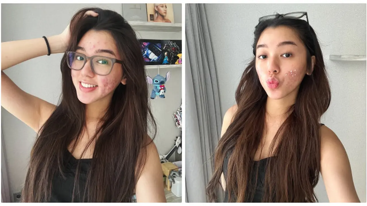 6 Potret Wajah Gabriella Ekaputri Berjerawat, Tetap Percaya Diri Tampil Natural
