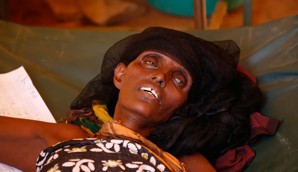Seorang wanita yang menderita malnutrisi di kamp IDP di Baidoa, Somalia, Selasa (7/3). Lebih dari 100 orang telah meninggal akibat bencana kekeringan ini. (AP/Khaled Kazziha)
