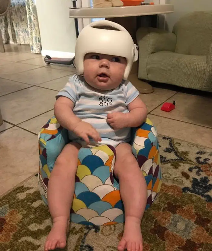 Jonas Gutierrez divonis mengalami sindrom Plagiocephaly yang mengharuskannya mengenakan helm untuk melindungi kepalanya tersebut. (Foto: boredpanda.com)