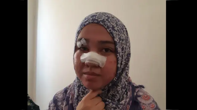 Pertahankan Tas dari Begal, Gadis Makassar Nyaris Kehilangan Hidung