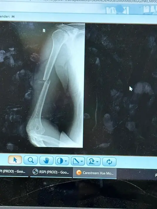 "Progresnya cepet banget cuma masih sakit. Kadang-kadang suka ngilu. Namanya dipasang pen kan. Terus patahnya yang bener-bener misah. Jadi harus disambung pakai pen," kata Zaskia Sungkar dilansir dari kanal Cumicumi. [Instagram/irwansyah_15]