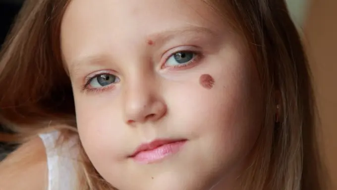 10 Tanda Lahir dan Tatto Bekas Luka yang Keren Banget