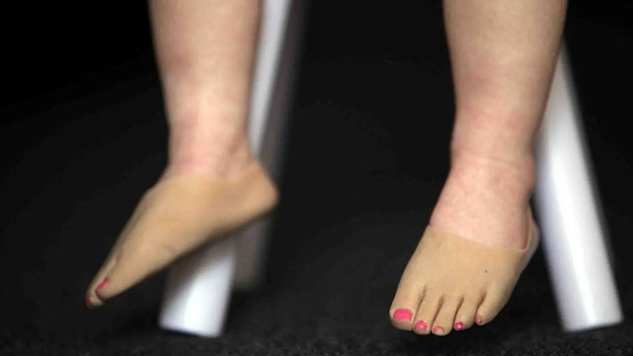 Kehilangan Kaki, Gadis Mungil Ini Tetap Ingin Berjalan dan Menari