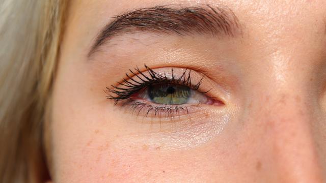 Ilustrasi gangguan mata akibat kolesterol