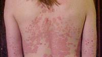 Psoriasis eritrodermik (sumber: wikipedia)