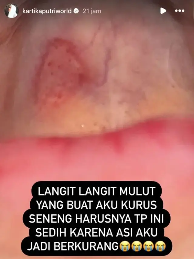 Kartika Putri kena ruam di wajahnya (Instagram/kartikaputriworld)