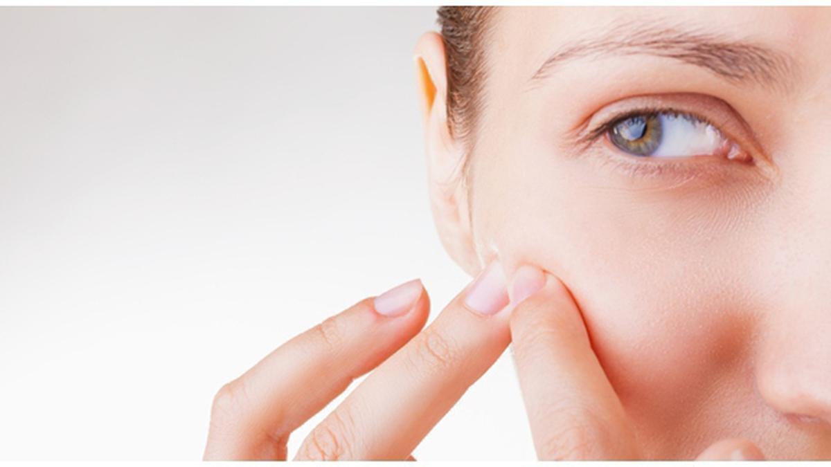 3 Hal Penting Diketahui Mengenai Perawatan Wajah Berjerawat - Beauty