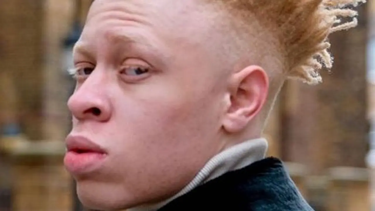 [Bintang] Saat Kecil Selalu Jadi Korban Bully, Kini Pria Albino Sukses Berkarier di Dunia Modelling