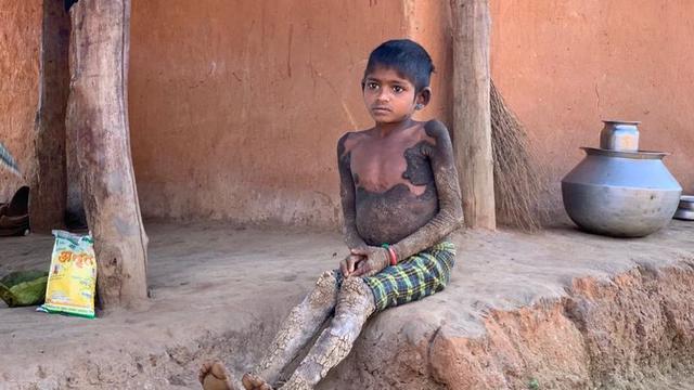 alami kelainan, gadis ini berubah jadi batu