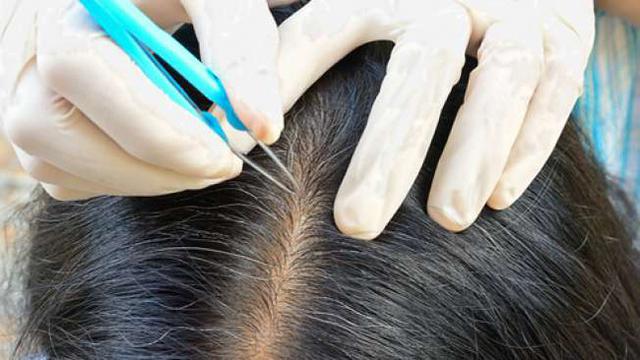 7 Cara Alami Hilangkan Uban di Usia Muda