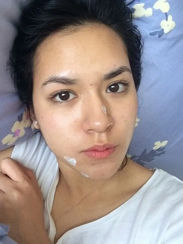 Potret 6 Seleb Unggah Foto Bare Face Lagi Berjerawat, Cintai Diri Sendiri Apa Adanya