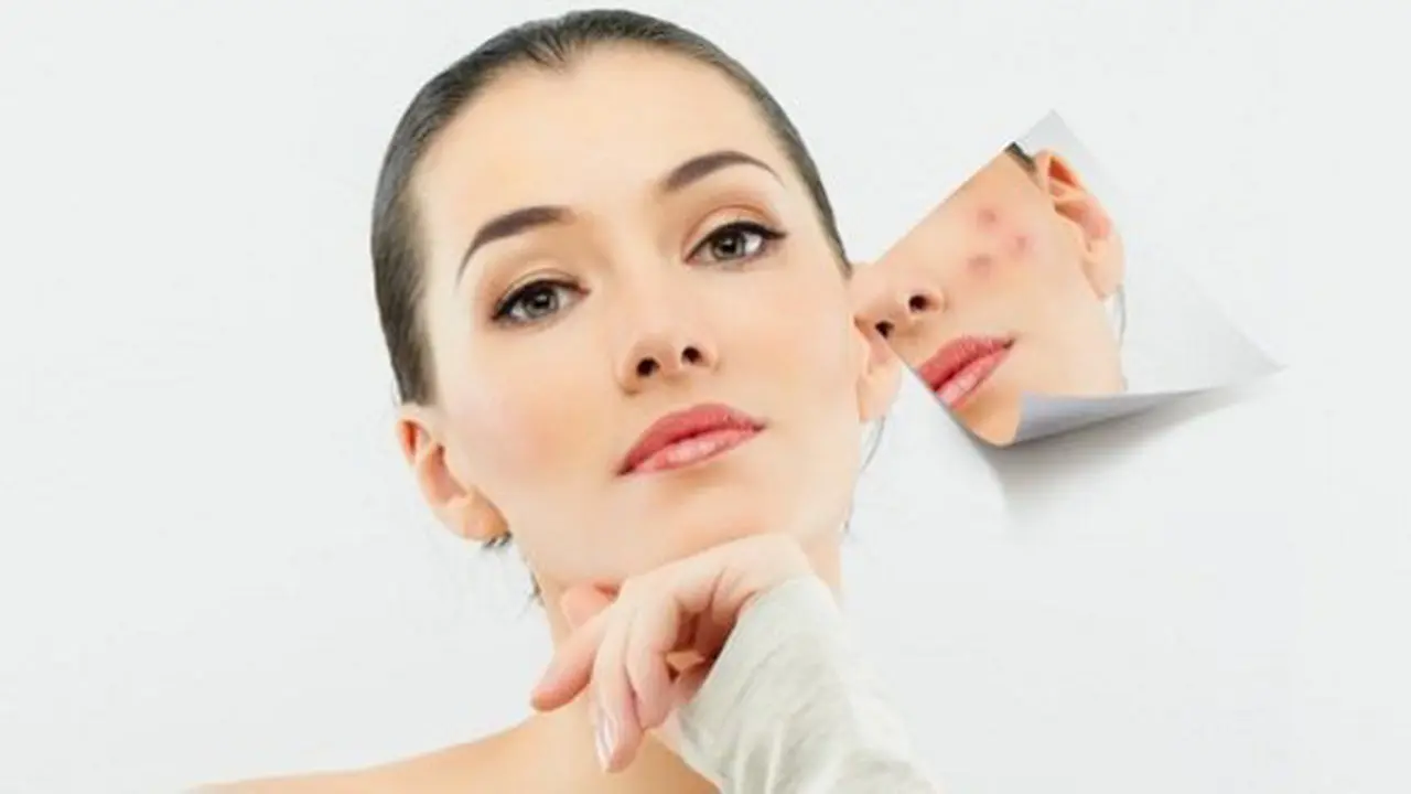 tips atasi jerawat / Copyright Shutterstock