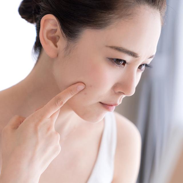 Hilangkan Jerawat Batu Dengan Cara Mudah Beauty Fimela Com